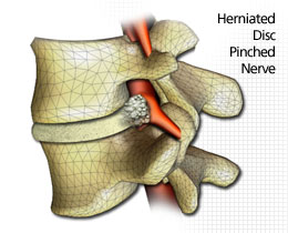 Slipped Disc with Pinched Nerve