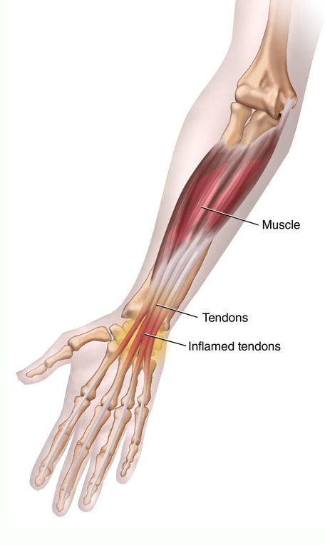 Wrist Tendonitis, self treatment
