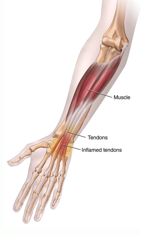 Тендинит запястья фото